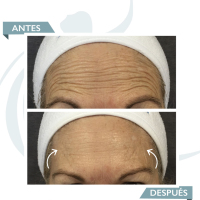 Smooth dynamic wrinkles antes y despues