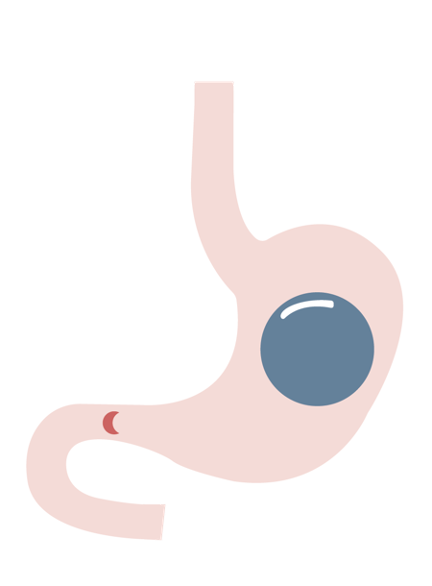 CIME Balón Intragastrico Obesidad Badalona Barcelona