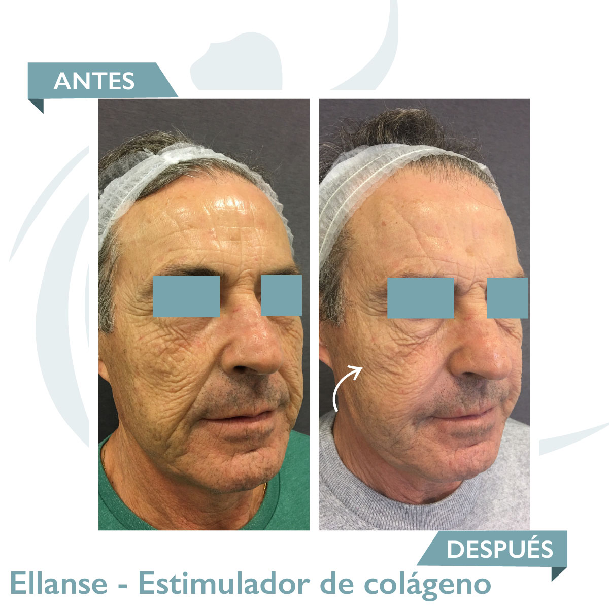 Ellanse - Estimulador de Colágeno