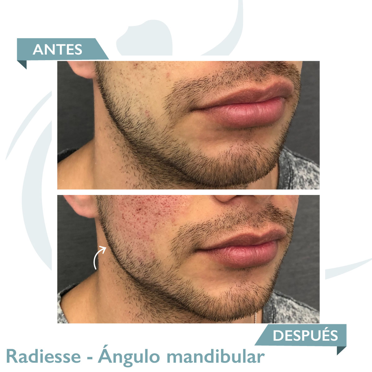 Lifting Facial Sin Cirugía Radiesse