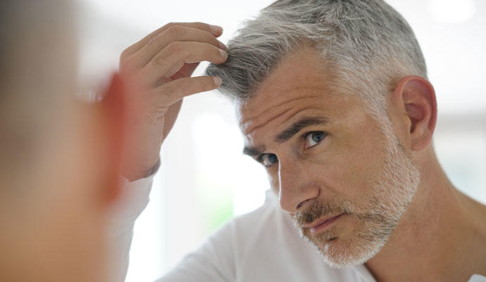 Barcelona hair graft. FUE micrograft Barcelona hair graft. FUE micrograft