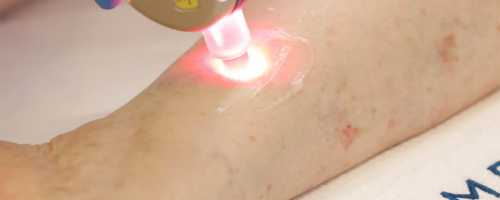 Vasculight laser for spider veins in Barcelona and Badalona