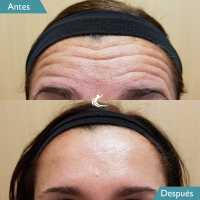 Suavizar arrugas dinámicas - Neuromoduladores antes y despues