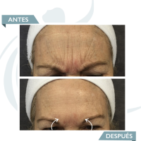 Smooth dynamic wrinkles antes y despues