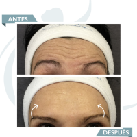 Smooth dynamic wrinkles antes y despues