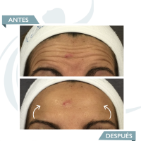 Smooth dynamic wrinkles antes y despues