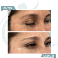 Smooth dynamic wrinkles antes y despues