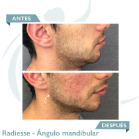 Radiesse - Lifting Without Surgery antes y despues