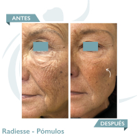 Radiesse - Lifting Without Surgery antes y despues