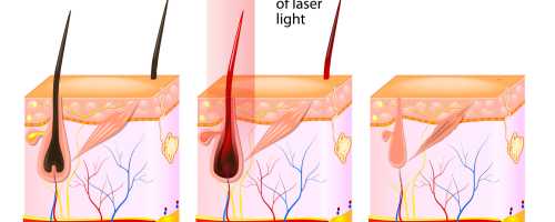 Laser hair removal treatment in Barcelona and Badalona