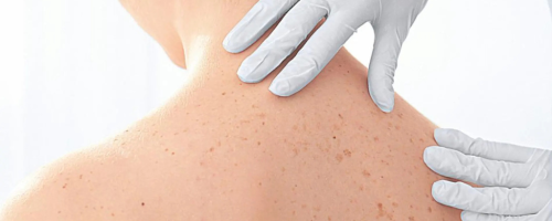 Dile adiós a los puntos rubí con un tratamiento láser seguro y eficaz