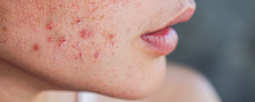 Descubre cómo eliminar el acné y mejorar la salud de tu piel con tratamientos personalizados