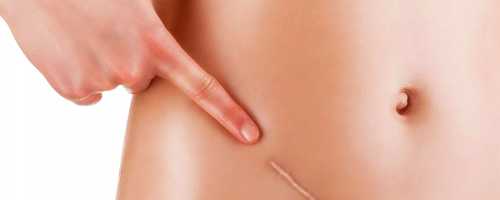 Corrective scar surgery in Barcelona and Badalona
