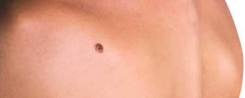 Treatment for the removal of moles and warts in Barcelona and Badalona