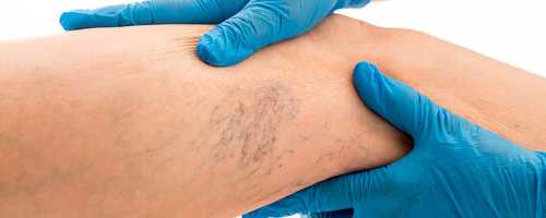 Treatment for varicose veins removal in Barcelona and Badalona
